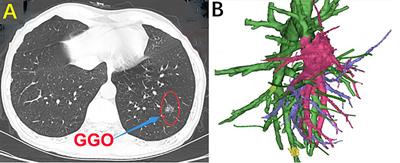 Clinical application of VATS combined with 3D-CTBA in anatomical basal segmentectomy